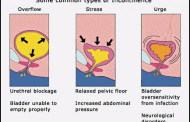 Common type of urine Incontinence