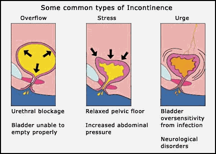 Common type of urine Incontinence