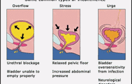 Common type of urine Incontinence